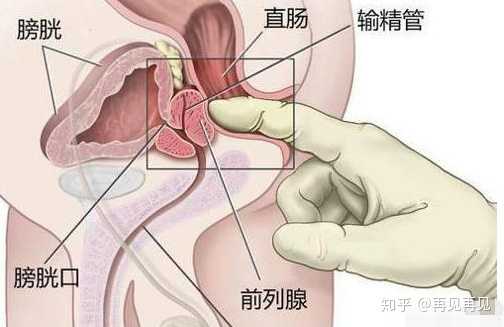 最新前列腺治疗方法，探索与突破的成果分享